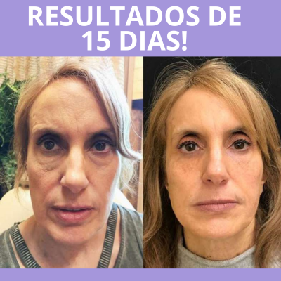 BotoxLaser - Acabe Com as Rugas em 7 dias + BRINDE EXCLUSIVO